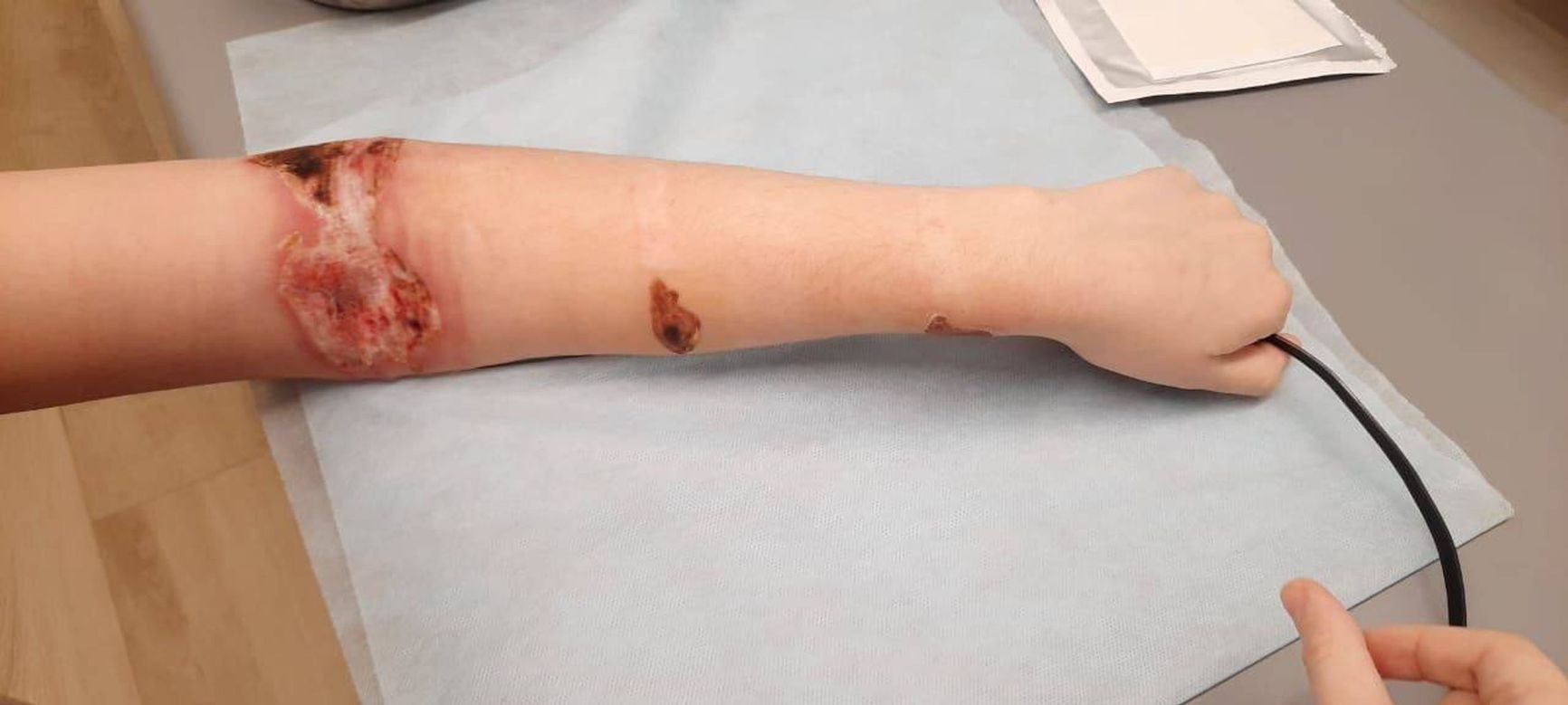 Viktoriia Budkina’s arm